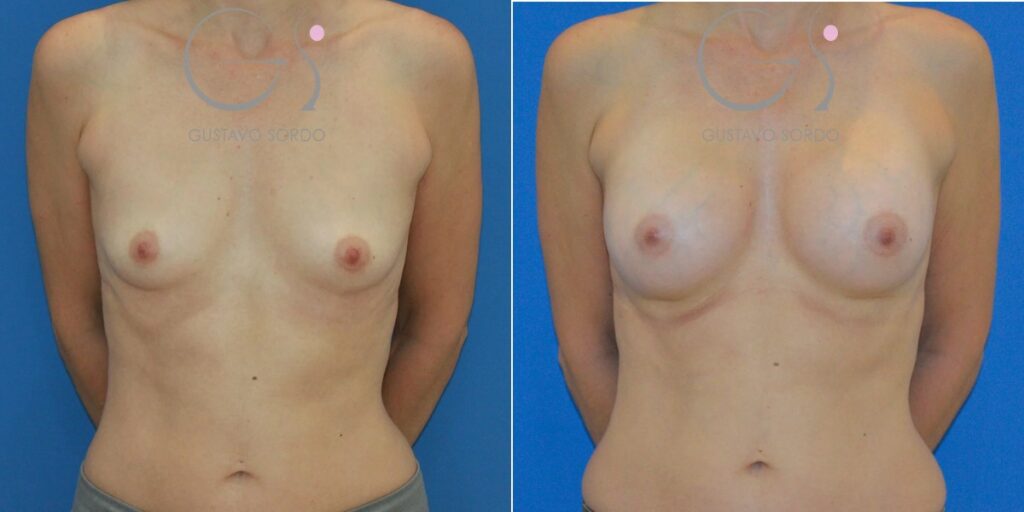 Antes y después de aumento de pecho con prótesis anatómicas de 280 cc en mujer de 43 años, Dr. Gustavo Sordo
