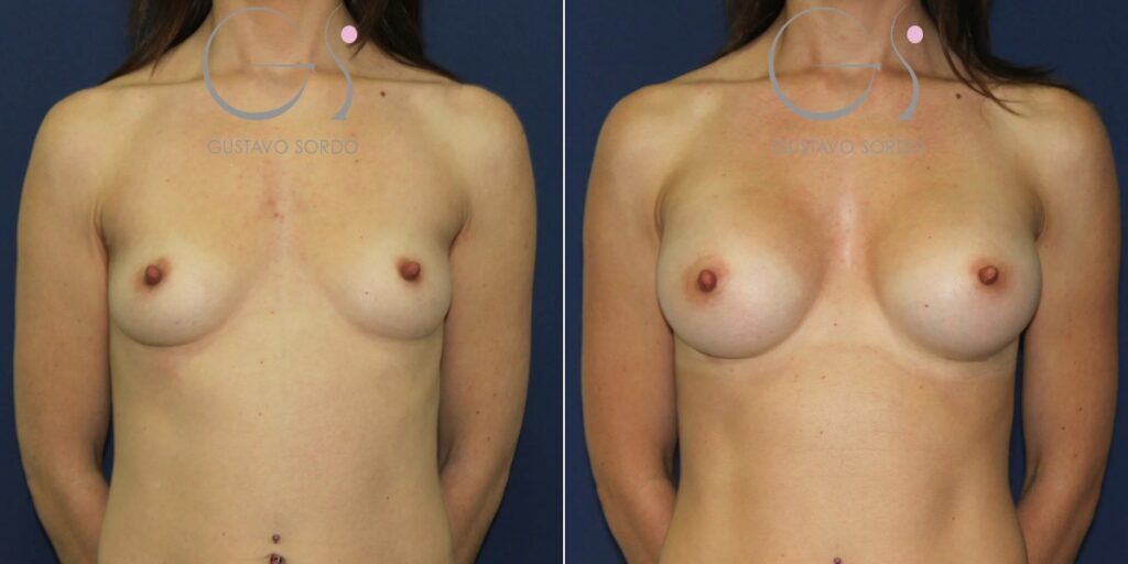 Antes y después de aumento de pecho en mujer delgada con prótesis anatómicas de 295 cc, Dr. Gustavo Sordo