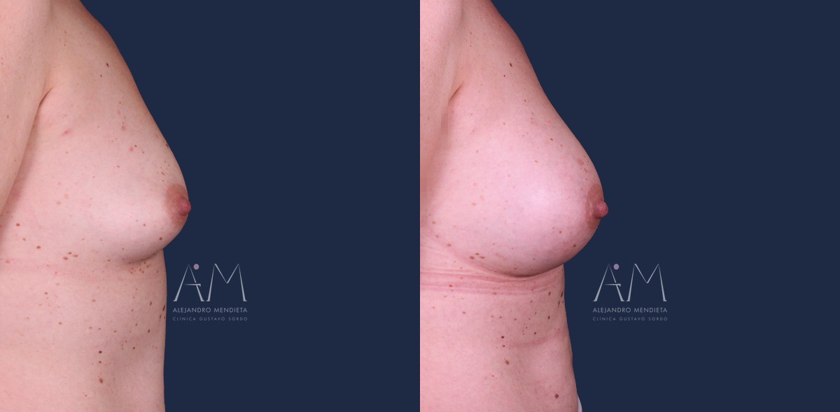 Aumento de pecho con técnica Preservé e implantes de 275 cc, antes y después a los cinco meses, perfil derecho. Caso operado en la Clínica Dr. Gustavo Sordo, Madrid, con la técnica Preservé del Dr. Alejandro Mendieta.