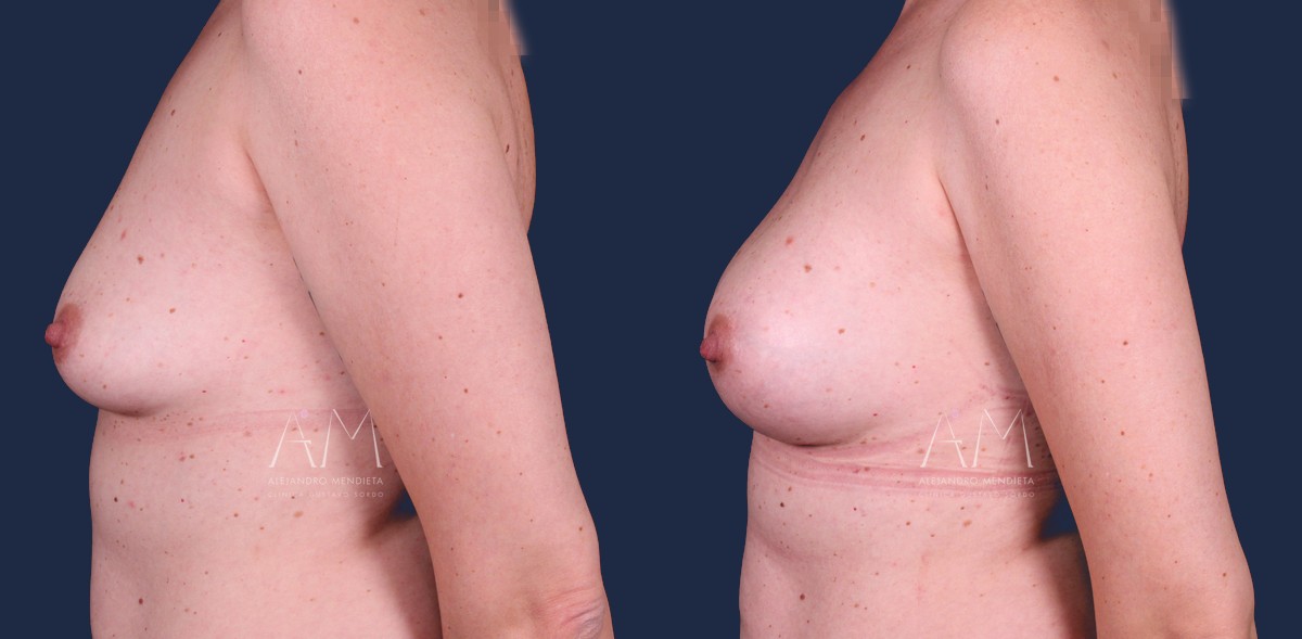 Aumento de pecho con técnica Preservé e implantes de 275 cc, antes y después a los cinco meses, perfil izquierdo. Caso operado en la Clínica Dr. Gustavo Sordo, Madrid, con la técnica Preservé del Dr. Alejandro Mendieta.