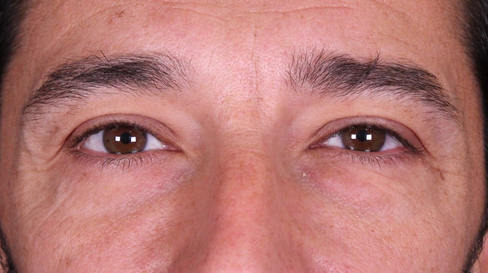 Blefaroplastia doble con transposición de bolsas, antes de la operación (1)