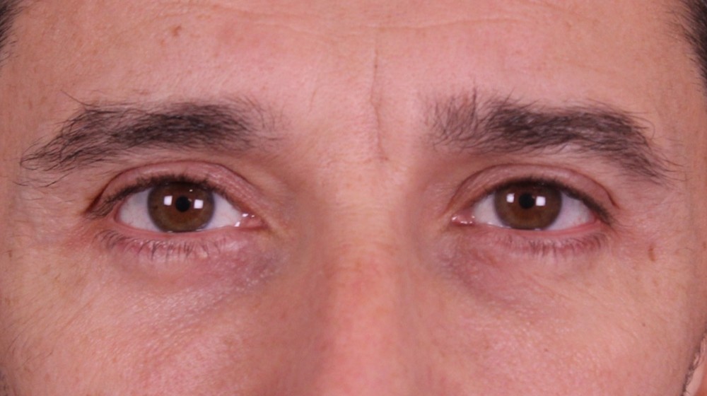 Blefaroplastia doble con transposición de bolsas, después de la operación (1)