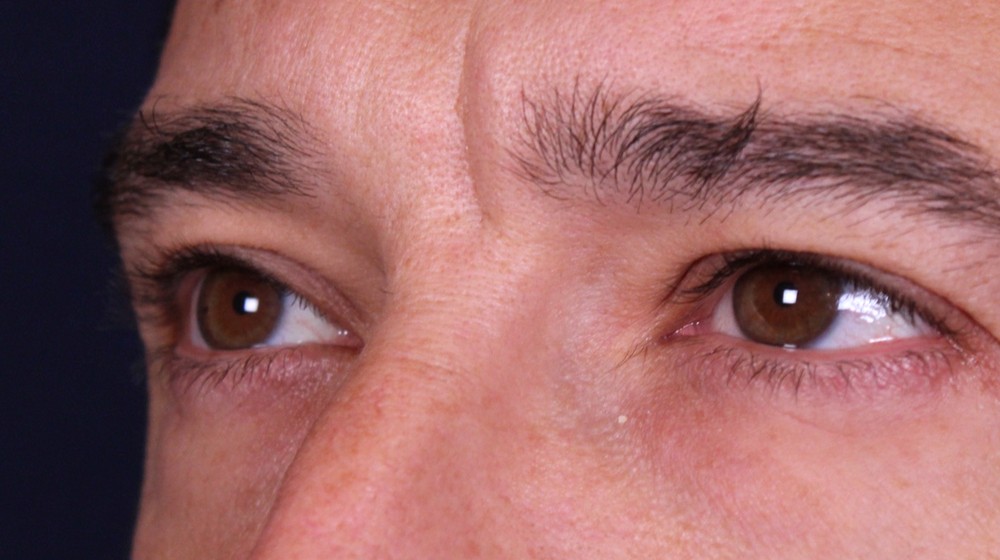 Blefaroplastia doble con transposición de bolsas, antes de la operación (2)