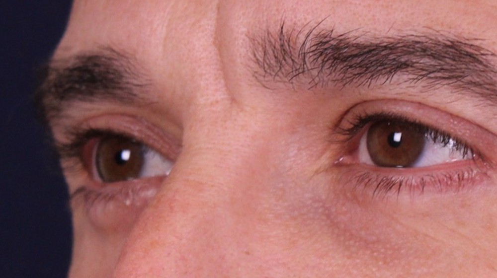 Blefaroplastia doble con transposición de bolsas, después de la operación (2)