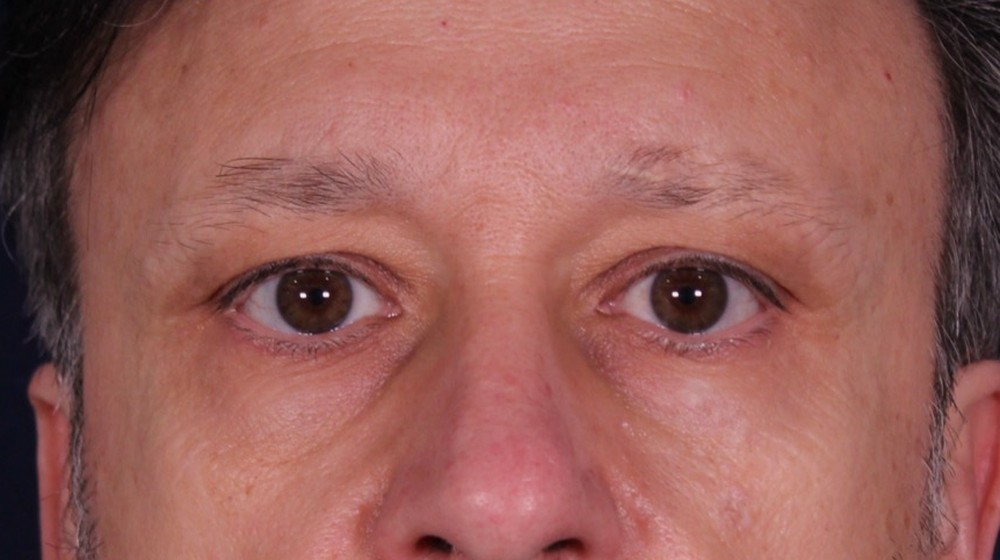 Lifting directo de cejas con blefaroplastia superior e inferior, antes de la operación (1)