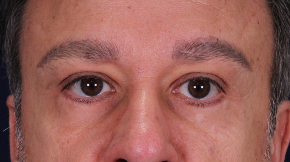 Lifting directo de cejas con blefaroplastia superior e inferior, después de la operación (1)