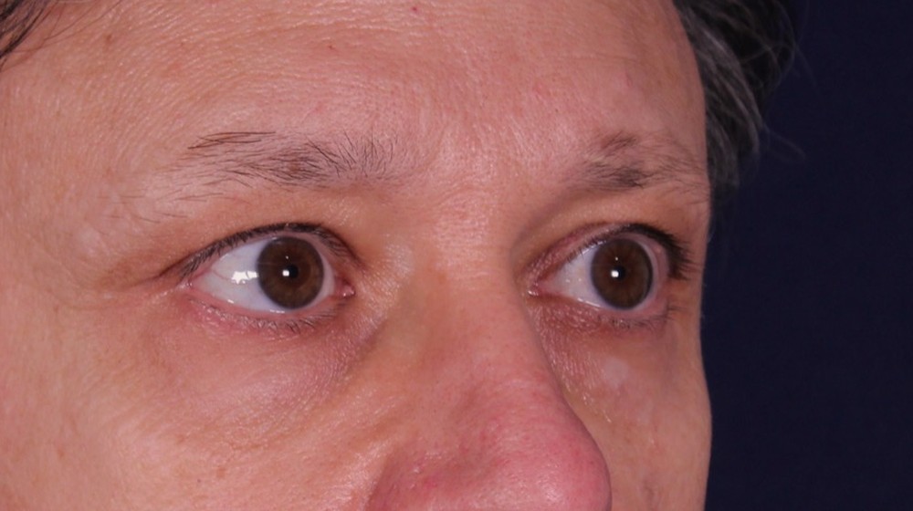 Lifting directo de cejas con blefaroplastia superior e inferior, antes de la operación (2)