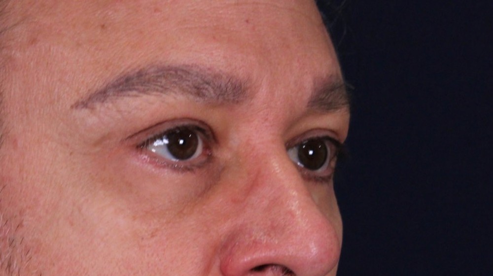 Lifting directo de cejas con blefaroplastia superior e inferior, después de la operación (2)