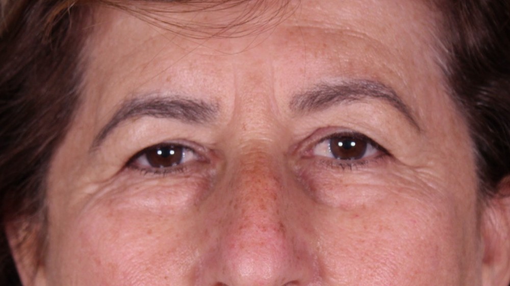 Blefaroplastia doble con lifting directo de cejas, antes de la operación (1)