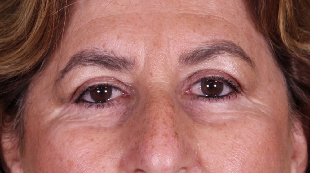 Blefaroplastia doble con lifting directo de cejas, después de la operación (1)