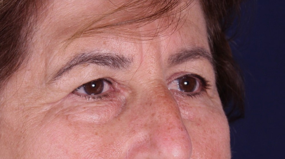 Blefaroplastia doble con lifting directo de cejas, antes de la operación (2)