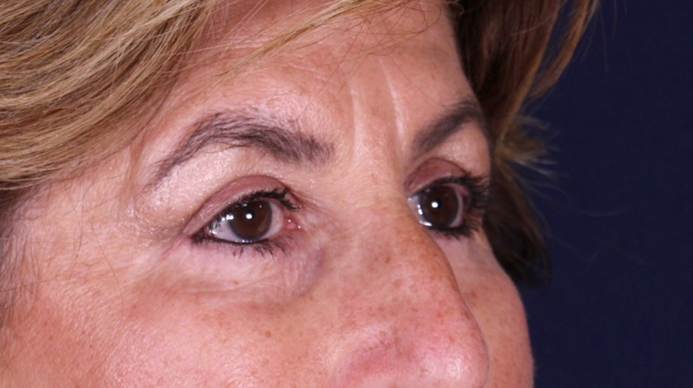 Blefaroplastia doble con lifting directo de cejas, después de la operación (2)