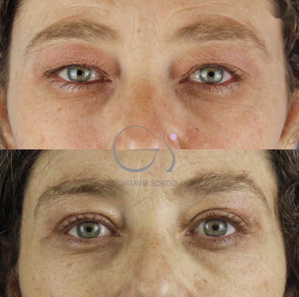 Antes y después de una blefaroplastia superior e inferior con suspensión directa de ceja, operada por el Dr. Gustavo Sordo