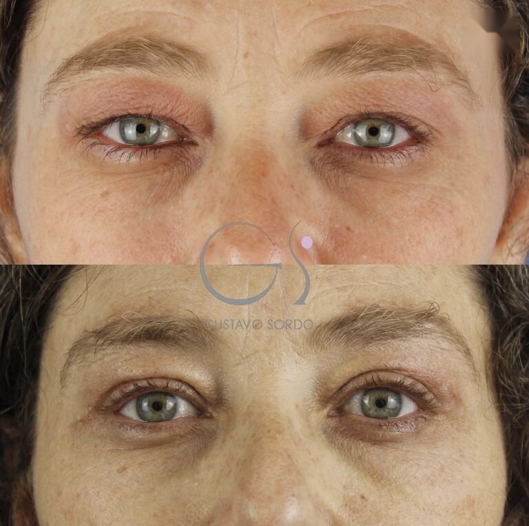 Antes y después de una blefaroplastia superior e inferior con suspensión directa de ceja, operada por el Dr. Gustavo Sordo