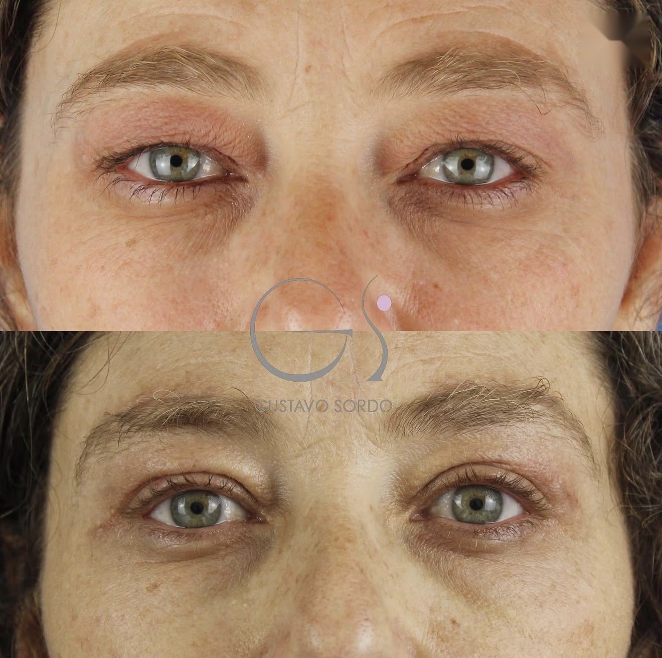 Antes y después de una blefaroplastia superior e inferior con suspensión directa de ceja, operada por el Dr. Gustavo Sordo