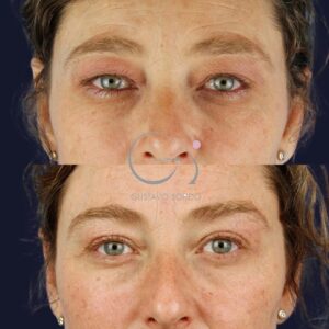 Blepharoplasty in a 55-year-old woman
