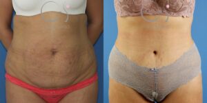 Abdominoplastie chez une femme présentant des vergetures