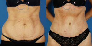 Liposuccion et abdominoplastie chez une femme de 45 ans