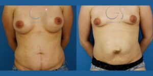 Abdominoplastie avec reconstruction d'une hernie abdominale