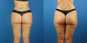 Lipoaspiração tumescente em pernas e glúteos