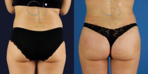 Lipoaspiração e aumento de glúteos em mulher de 39 anos