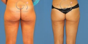 Lipoaspiração e aumento de glúteos com lipofilling