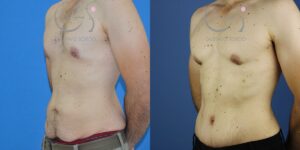 Ginecomastia, abdominoplastia y liposucción