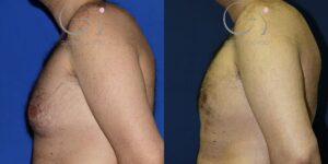 Ginecomastia: fotos del antes y después hombre 35 años