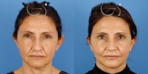Lifting y rinoplastia: resultados tras 15 días