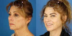 Lifting de cara, cuello, cejas y blefaroplastia