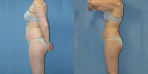 Lipoaspiração em diversas áreas