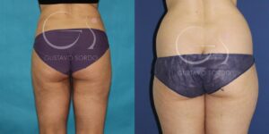 Lipoaspiração em mulher de 38 anos antes e depois