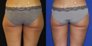Lipoaspiração em uma mulher de 26 anos