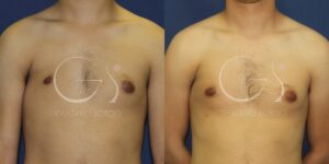 Lipofilling en hombre de 25 años