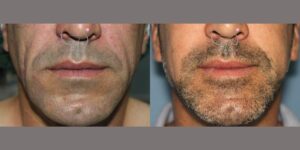 Lipofilling en hombre de 43 años