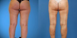 Lipofilling de gemelos y liposucción