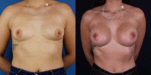 Mamas tuberosas corregidas con prótesis anatómicas de 375 cc