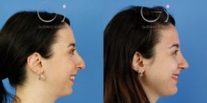 Resultado tras 6 semanas de una rinoplastia y mentoplastia