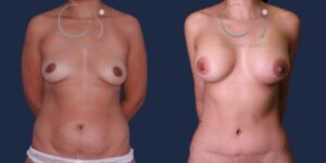 Mommy makeover: aumento de pecho y abdominoplastia