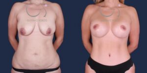 Mujer mommy makeover n s p