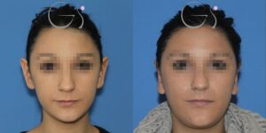 Orelhas de abano corrigidas com otoplastia