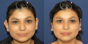 Otoplastia com técnica combinada