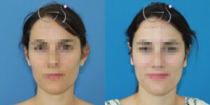Otoplastia em mulher de 32 anos