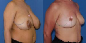Gigantomastia resuelta con una reducción de mamas