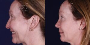Rinoplastia secundaria: antes y después de perfil