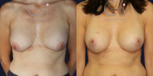 Cambio de implantes con mastopexia en T invertida