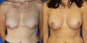Cambio de implantes con mastopexia en t invertida 2
