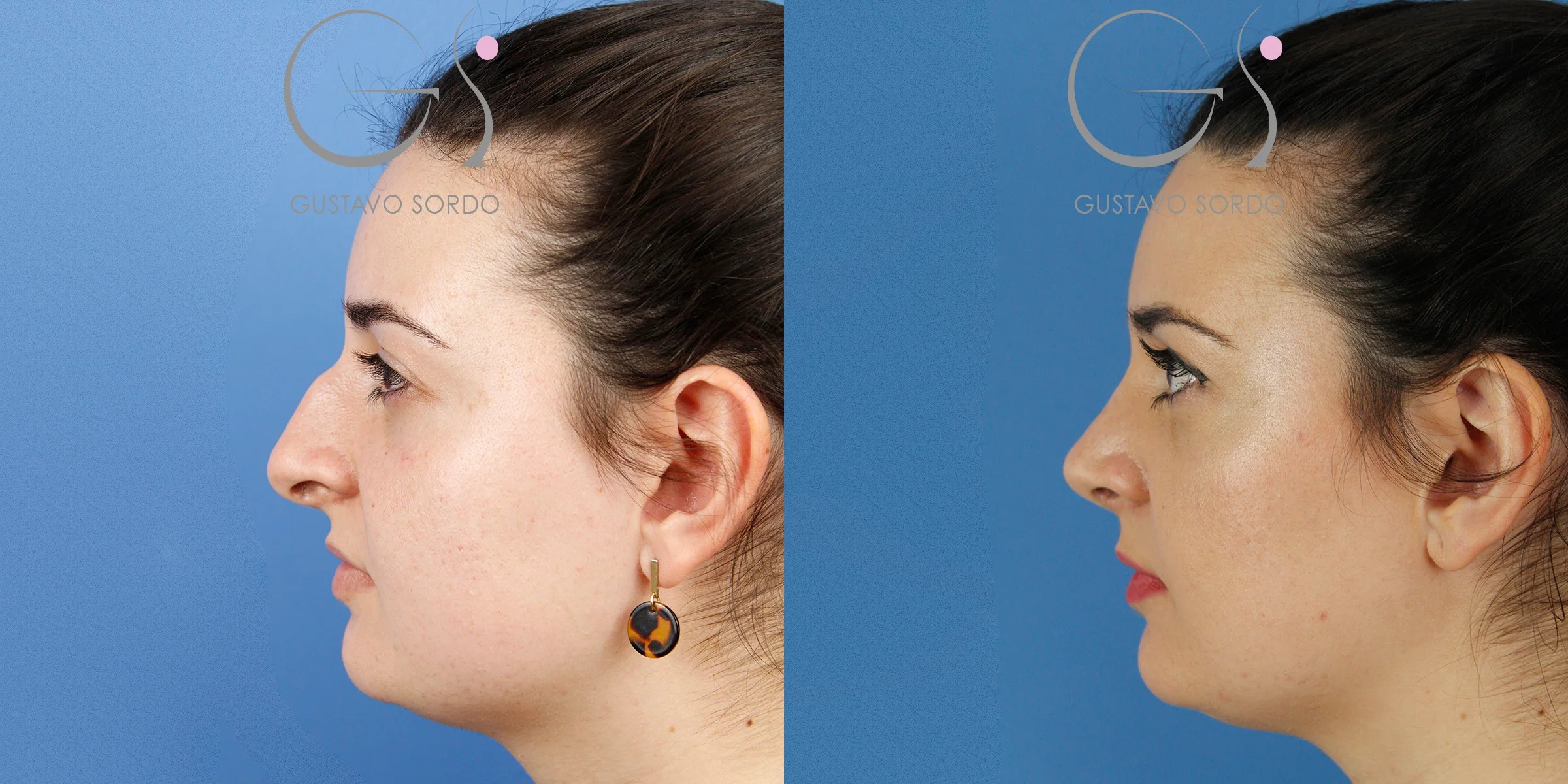 Rinoplastia ultrasónica en un dorso en S con giba marcada: perfil antes (izquierda) y después (derecha). Caso operado por el Dr. Gustavo Sordo en Madrid.