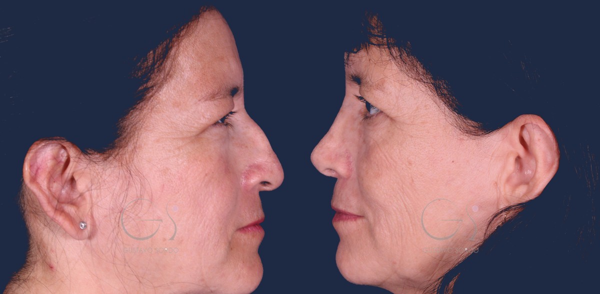 Rinoplastia etnica, antes y despues de perfil.