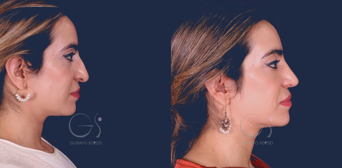 Rinoplastia etnica con preservacion del dorso, antes y despues de perfil al ano.